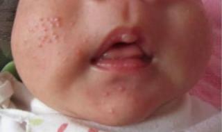 全国花粉过敏预警地图 全国花粉过敏预警地图